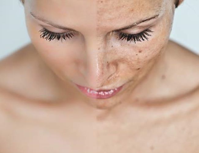 Las máscaras de las manchas seniles de pigmento